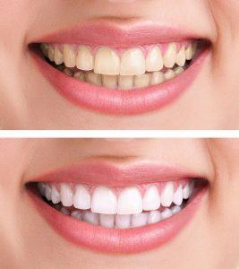 comparison of stained teeth and whitened teeth