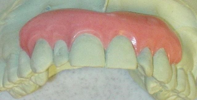 image of a gingival mask to help with black triangles