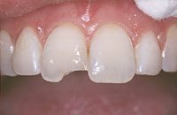 close-up of chipped front tooth before dental bonding