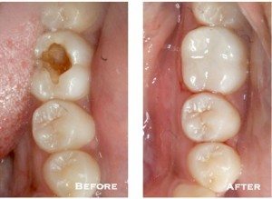 Copy of composite filling