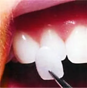 close-up of a porcelain veneer next to a patient's natural tooth
