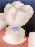 diagram of a porcelain crown fitting over a tooth