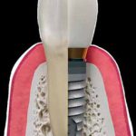 Copy of dental implants