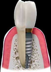 diagram of a dental implant 