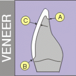 Copy of porcelain veneer margin