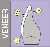 diagram of how a porcelain veneer fits onto the tooth