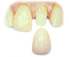 example of how a porcelain crown fits over tooth