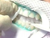 closeup of zoom whitening gum protection