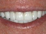 porcelain veneers1 after general