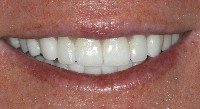 close-up of a porcelain veneers patient