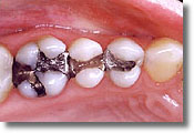 photo of amalgam, silver fillings