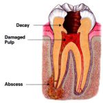 Copy of root canal abscess