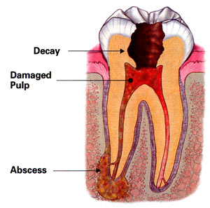 diagram of a tooth where a root canal has formed