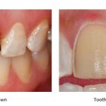 comparision of prep for crowns and prep for poreclain veneers