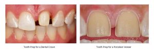 comparision of prep for crowns and prep for poreclain veneers