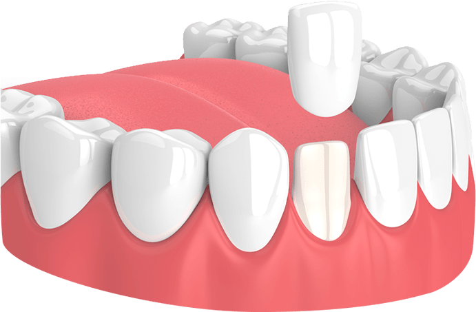 Veneers Example